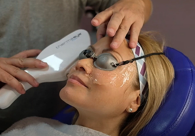 IPL Dry Eye Treatment