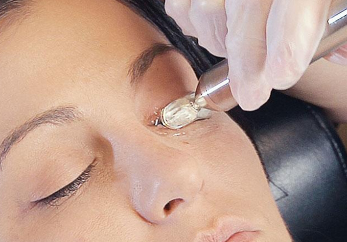 MiBoFlo Thermoflo Treatment